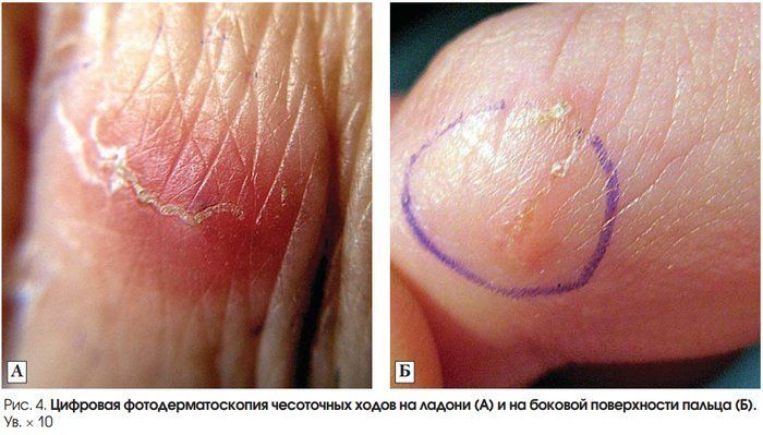 чесотка