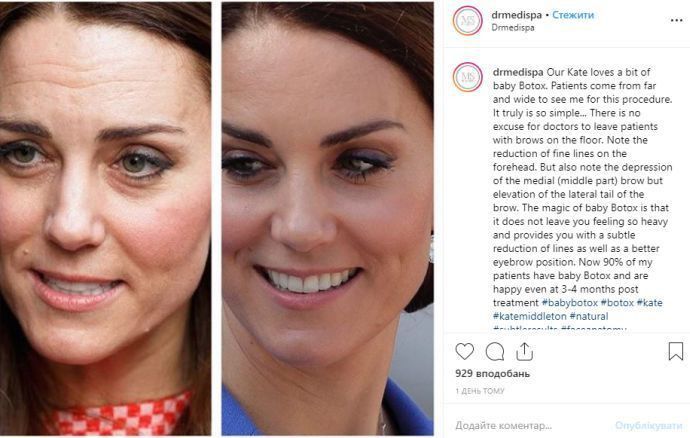 Кейт Миддлтон обвинили в злоупотреблении ботоксом: реакция дворца. Новости мира