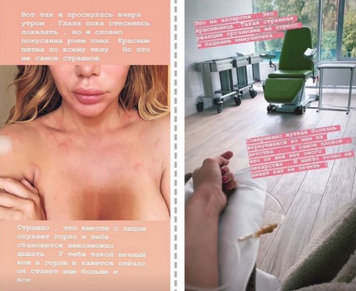 «‎Никто не знает, как лечить»‎: Анна Седокова напугала фанатов своим состоянием здоровья. Новости Украины