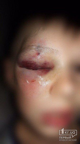 Гематомы закрыли глаз: мужчина избил школьника. Новости Днепра