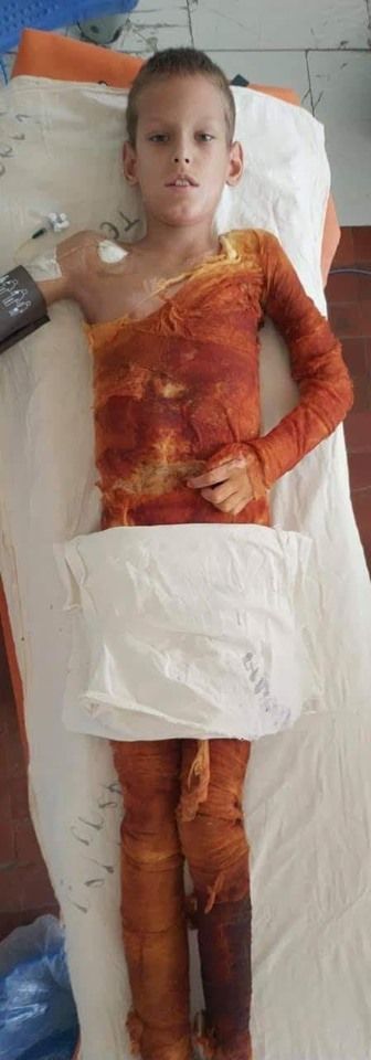 Облили бензином и подожгли: состояние пострадавшего ребенка. Новости Днепра