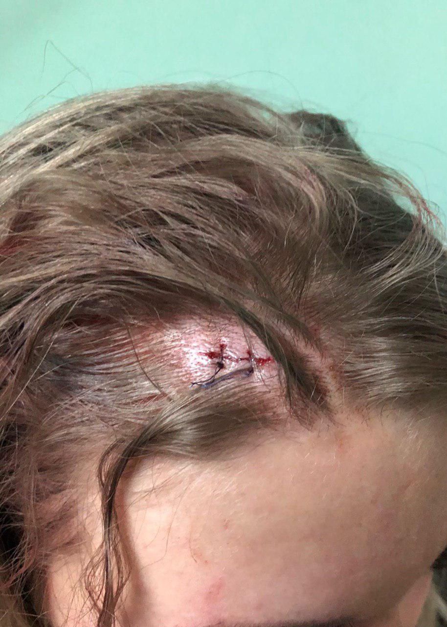 «Последствия непогоды»: в Днепре забор рассек голову девушке. Новости Днепра