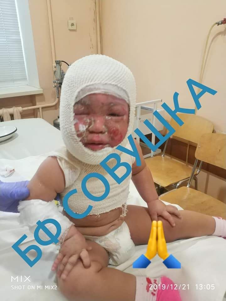 Девочка опрокинула на себя кипяток. Новости Днепра