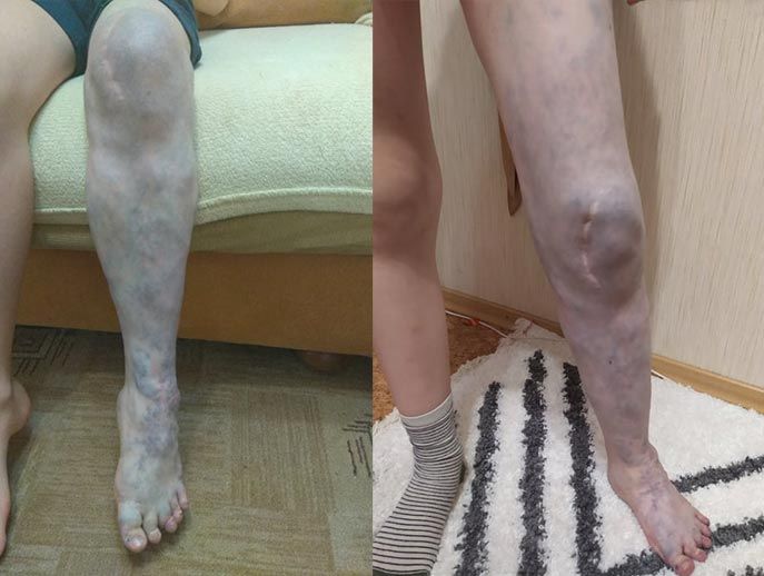 Давайте поможем Мише сохранить способность самостоятельно ходить!