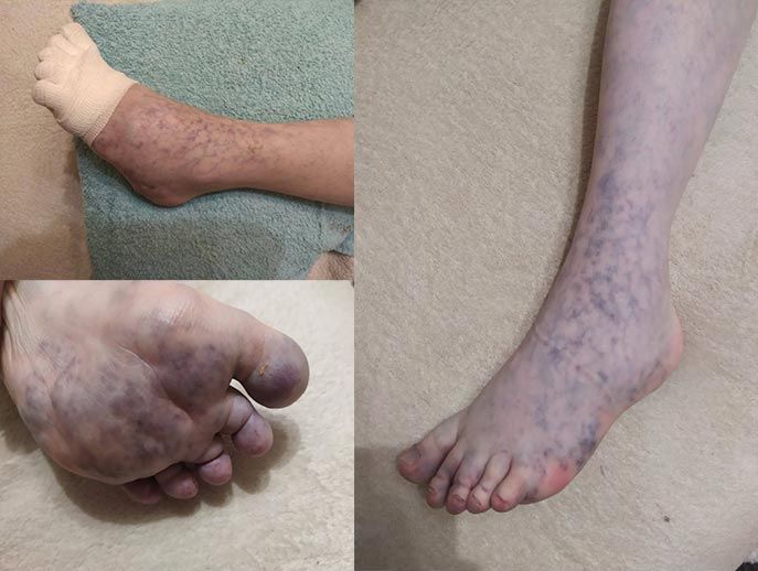 Давайте поможем Мише сохранить способность самостоятельно ходить!