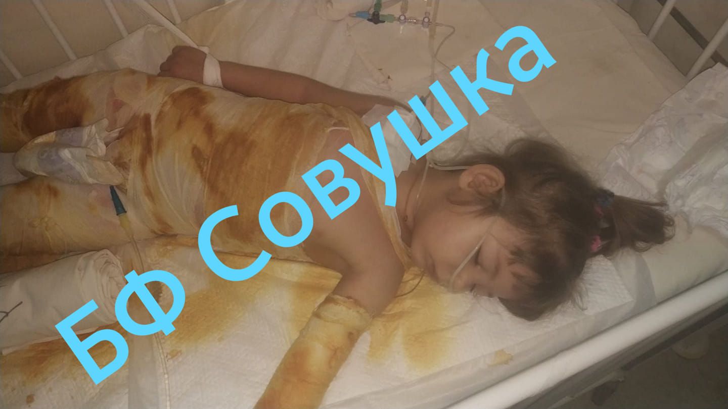 В Днепре маленькая девочка села в ведро с кипятком: нужна помощь. Новости Днепра