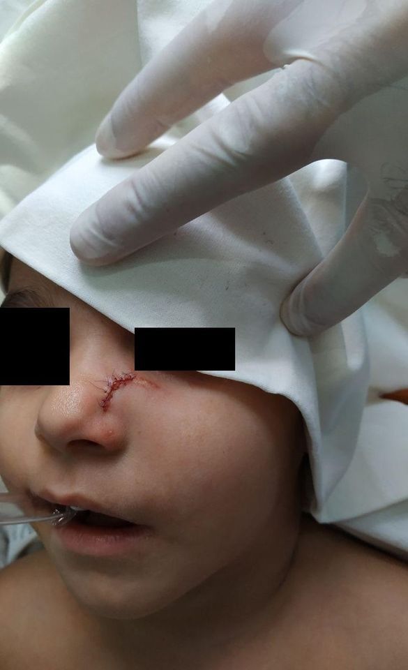 В Днепре девочка упала лицом на острый предмет. Новости Днепра