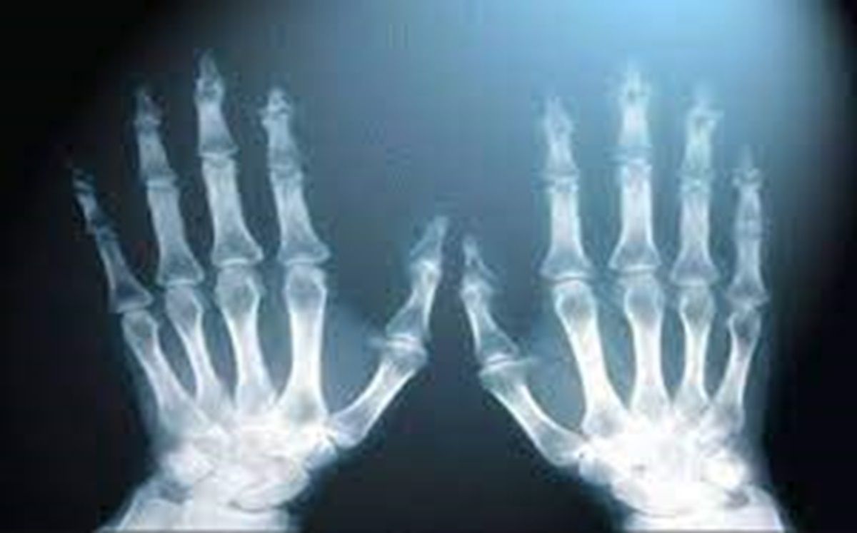 лучи рентгена