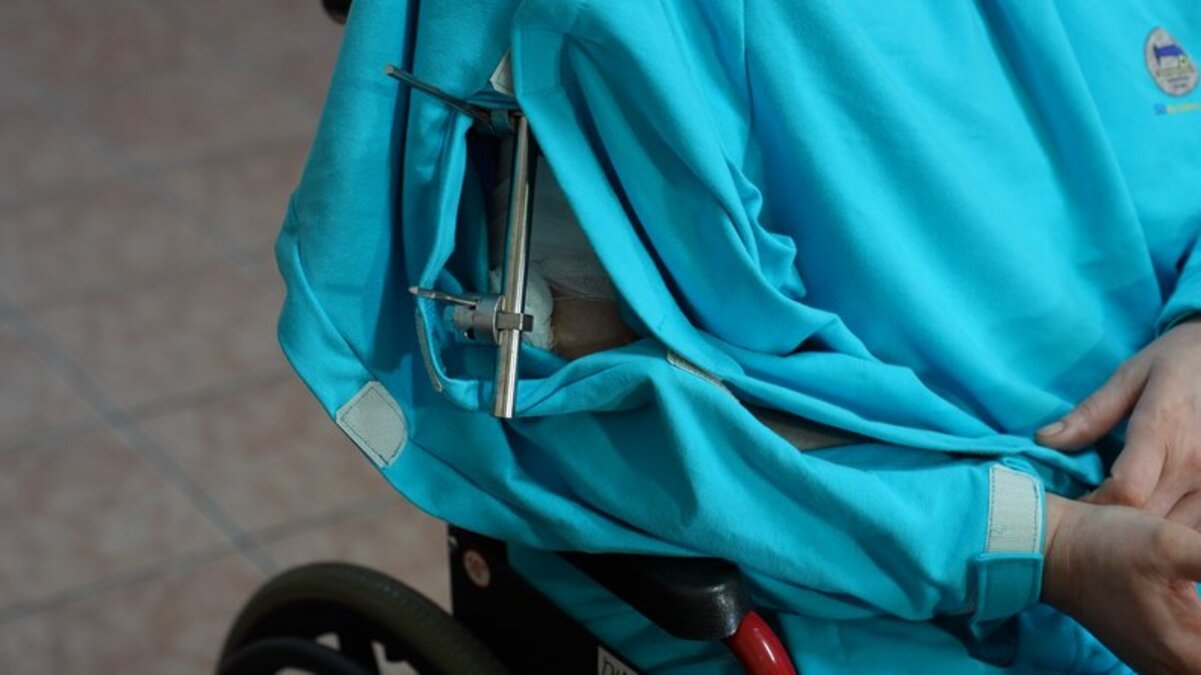 Рука трималася на клаптику шкіри: у Дніпрі рятують постраждалу після обстрілу 1 грудня